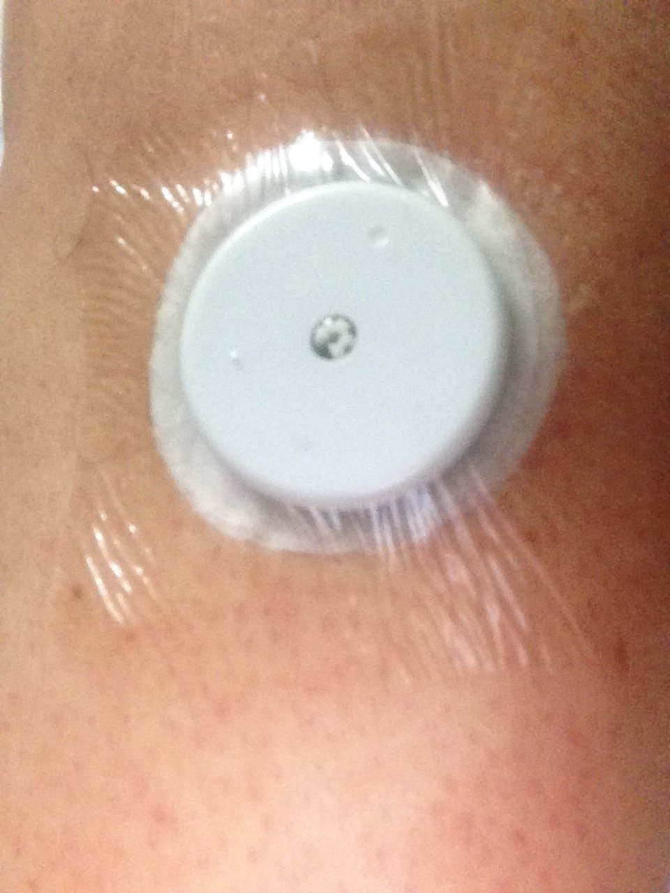 libre freestyle skin reaction diabetes poll had