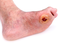 What are some diabetes symptoms related to the toes?