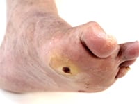 Diabetic Foot Ulcers - What You Need to Know - Drugs.com