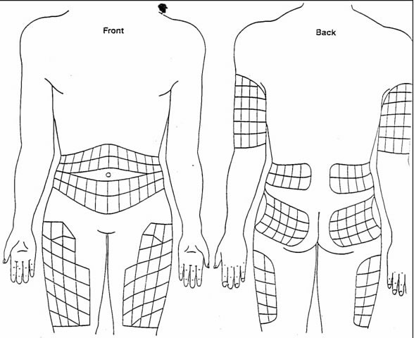 Copaxone Injection Sites Chart