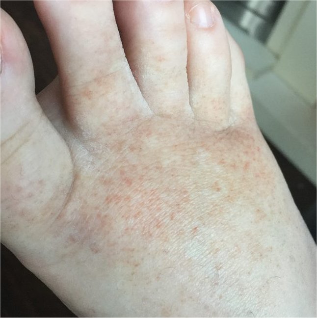 diabetes skin rash feet)