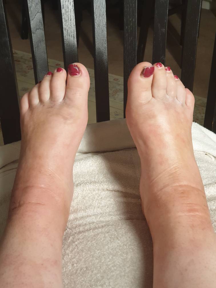 Pregnancy and bad feet swelling | Diabetes Forum • The Global Diabetes