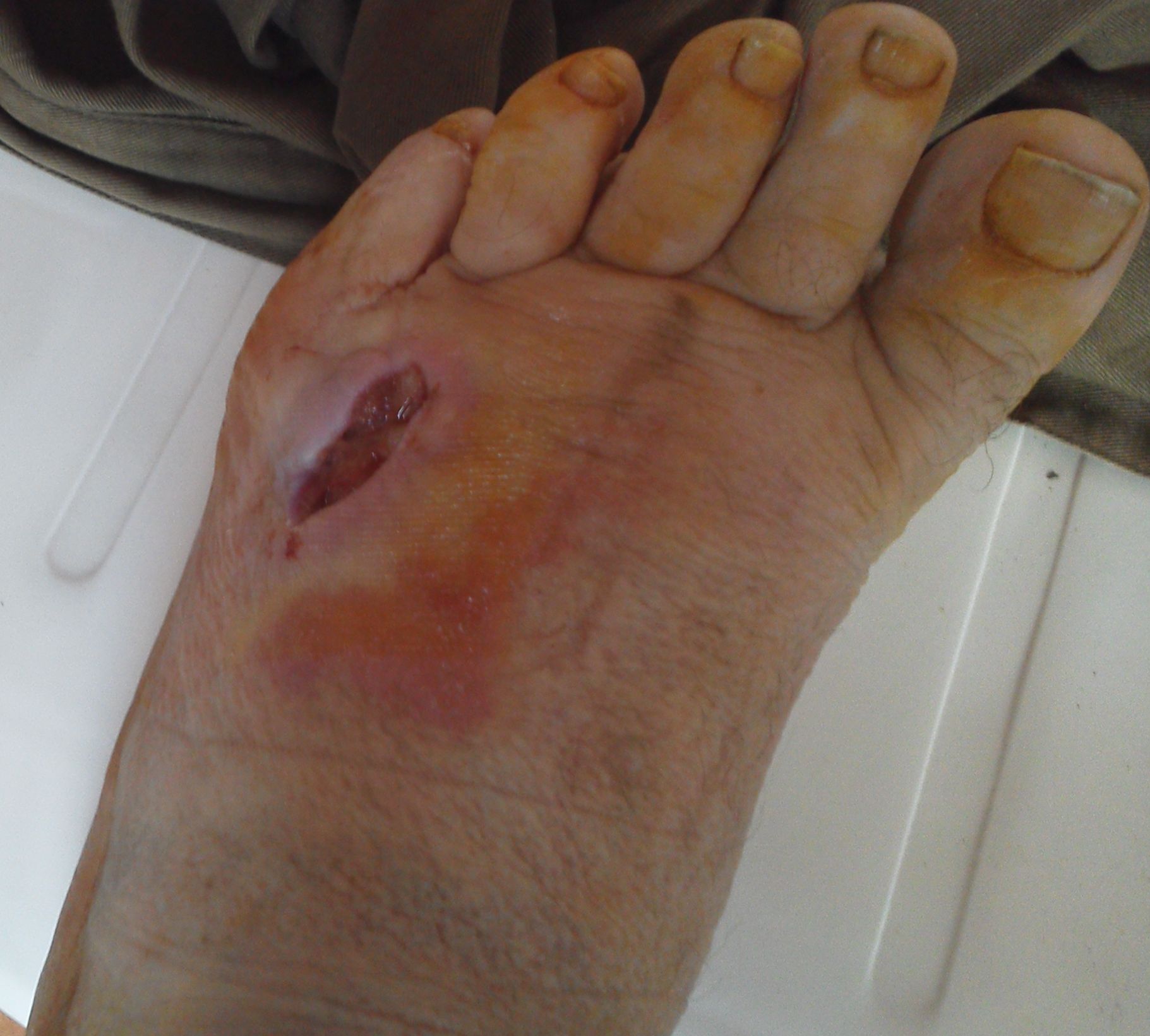 kens foot 31 august 2014 4 days after op.jpg