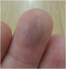 Finger bruise.png