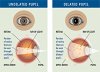 31184_dilated-pupils (1).jpg
