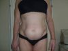 16.03lipohypertrophy.jpg