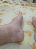 Lfootoedema.jpg