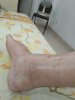 Rfootoedema.jpg
