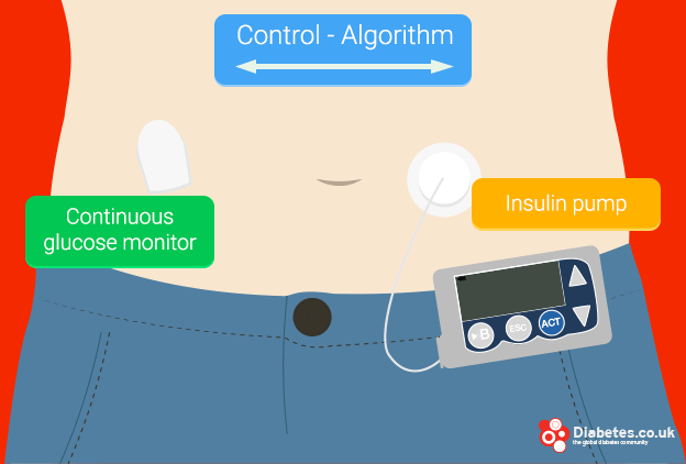Artificial pancreas: how it works