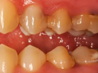 Gingivitis affects 50% of adults