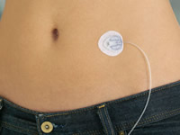 Insulin Pump Calculator