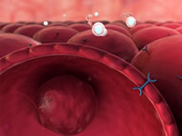 Insulinoma results in the excessive production on insulin