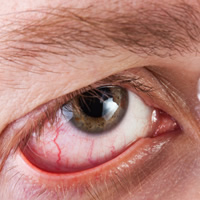 Retinal detachment affects 1 in 100,000 people each year