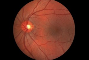 Diabetes can have severe complications if not tightly-managed - including retinopathy, and sometimes amputation.