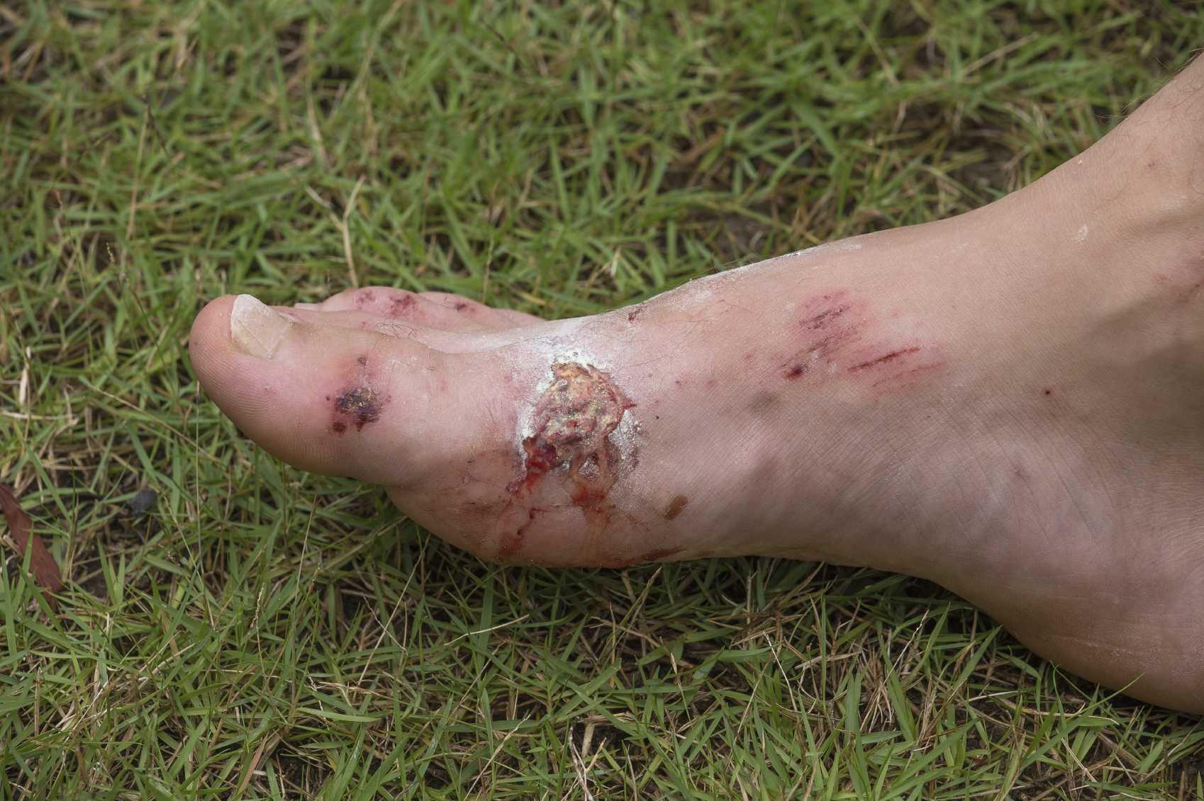 Foot Wounds and Infections