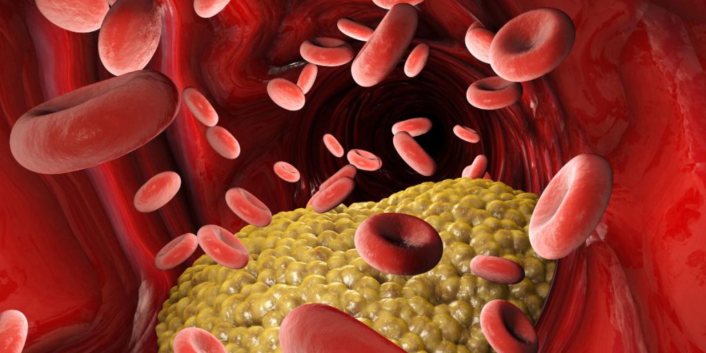 Steroid Induced Diabetes Cause, Symptoms & Treatment