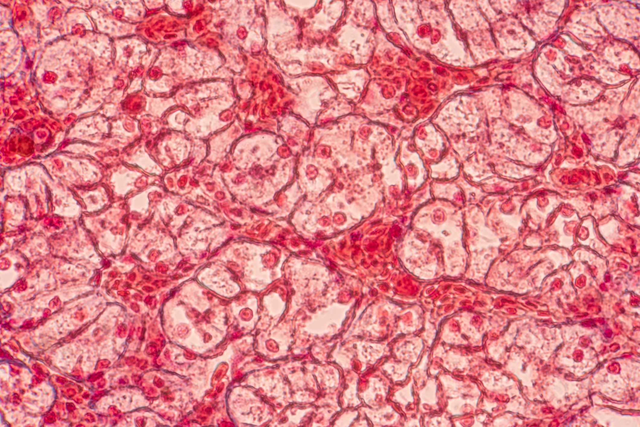Lipohypertrophy: Symptoms, Causes, Diagnosis, Treatment, And Coping