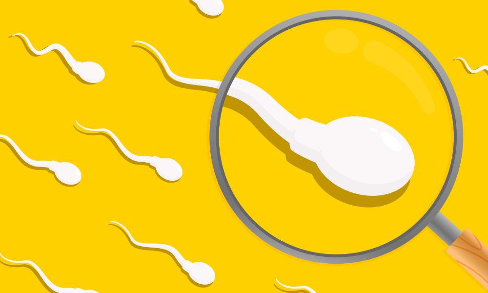 Male Infertility Retrograde Ejaculation, Sperm Quality and Count