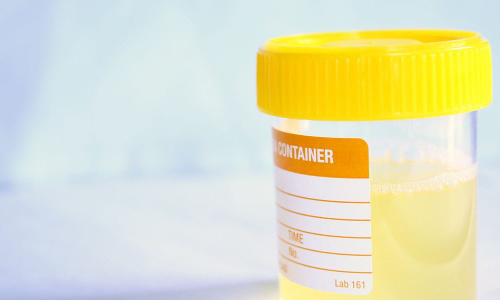 Ketonuria and Diabetes Symptoms, Treatment and Avoiding Ketonuria